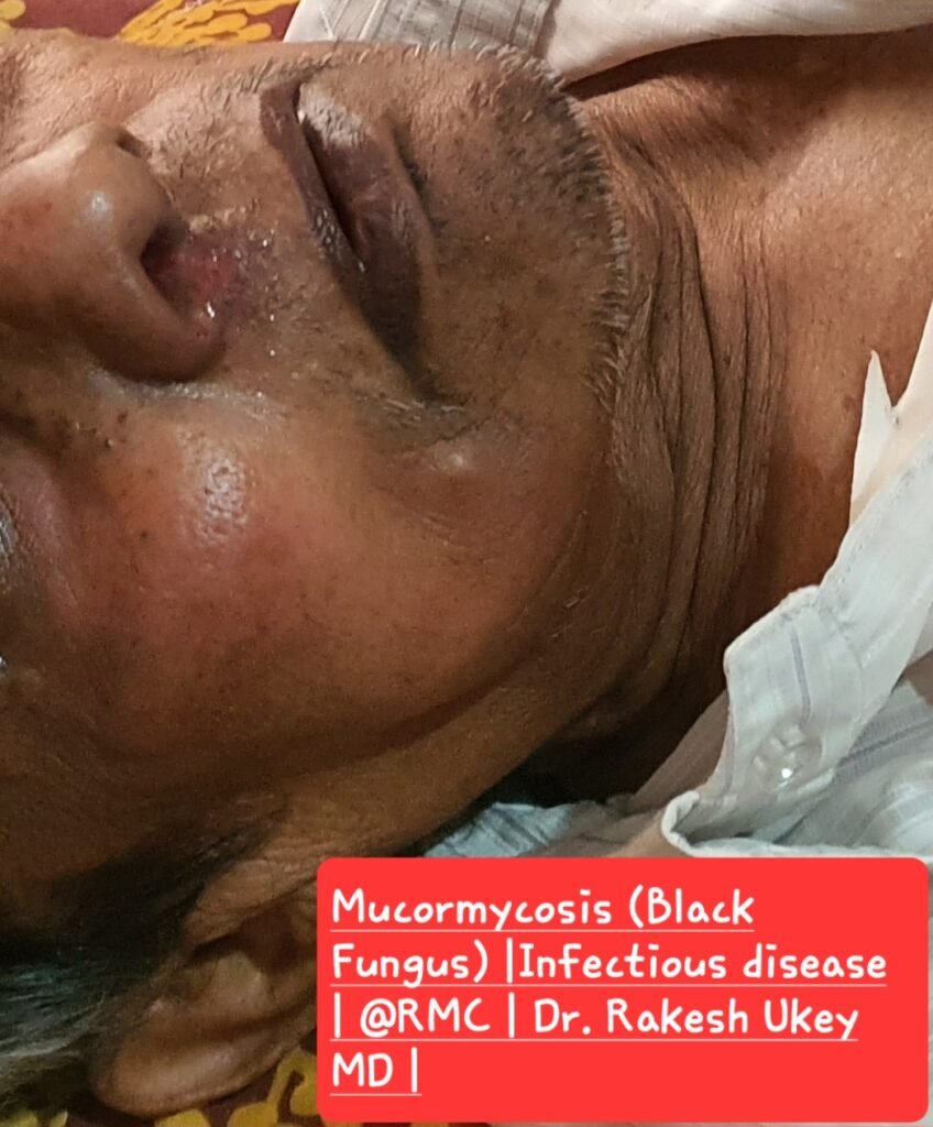 Mucormycosis (Black
Fungus) | Infectious disease |
@ RMC | Dr. Rakesh Ukey
MD