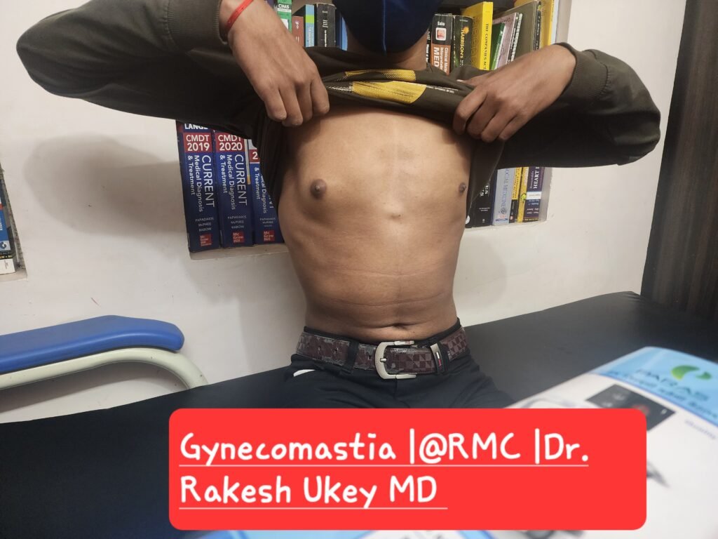 Gynecomastia unilateral @ RMC  CLINIC Dr. Rakesh Ukey MD 