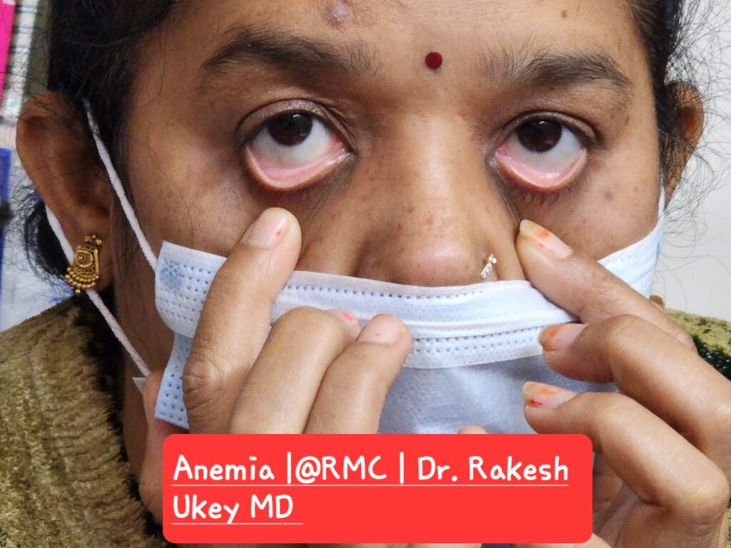 Anemia Hb 6.5 | Hematology | @ RMC | Dr. Rakesh Ukey MD 