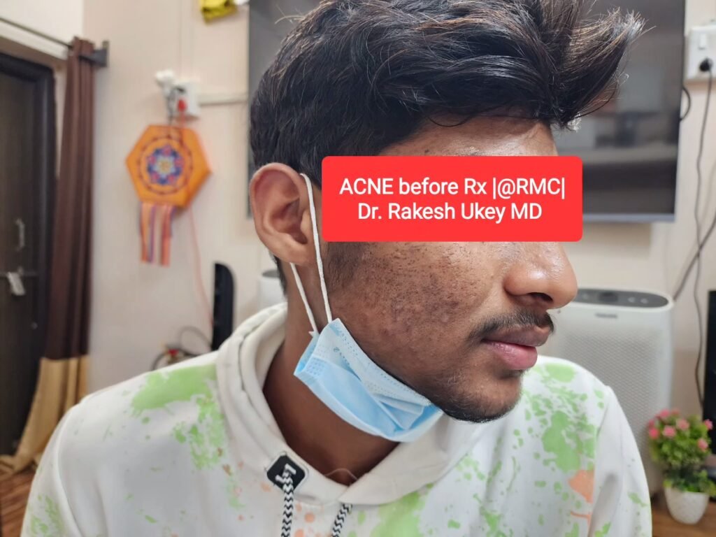 ACNE before Rx | @ RMC I
Dr. Rakesh Ukey MD