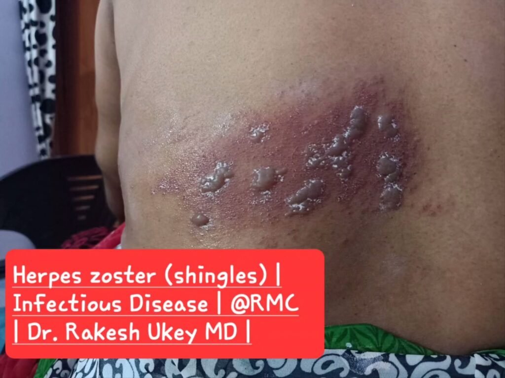 Herpes zoster (shingles) |
Infectious Disease I @RMC
| Dr. Rakesh Ukey MD